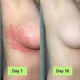 Clinical Antifungal Soap