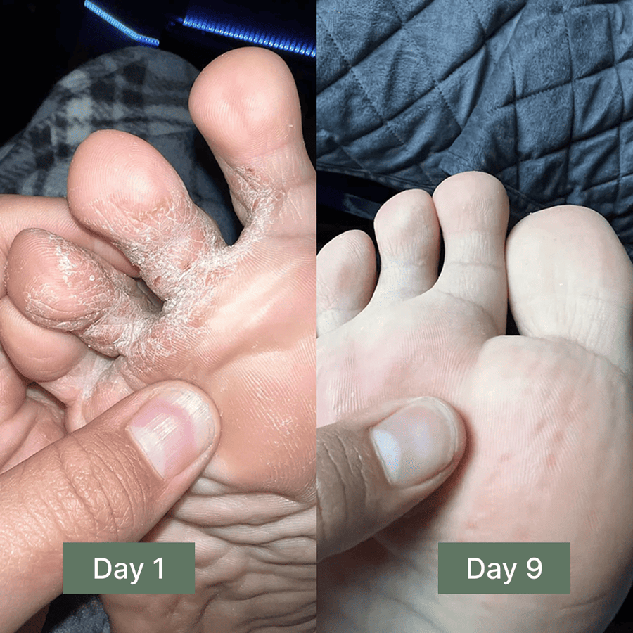 Clinical Antifungal Soap