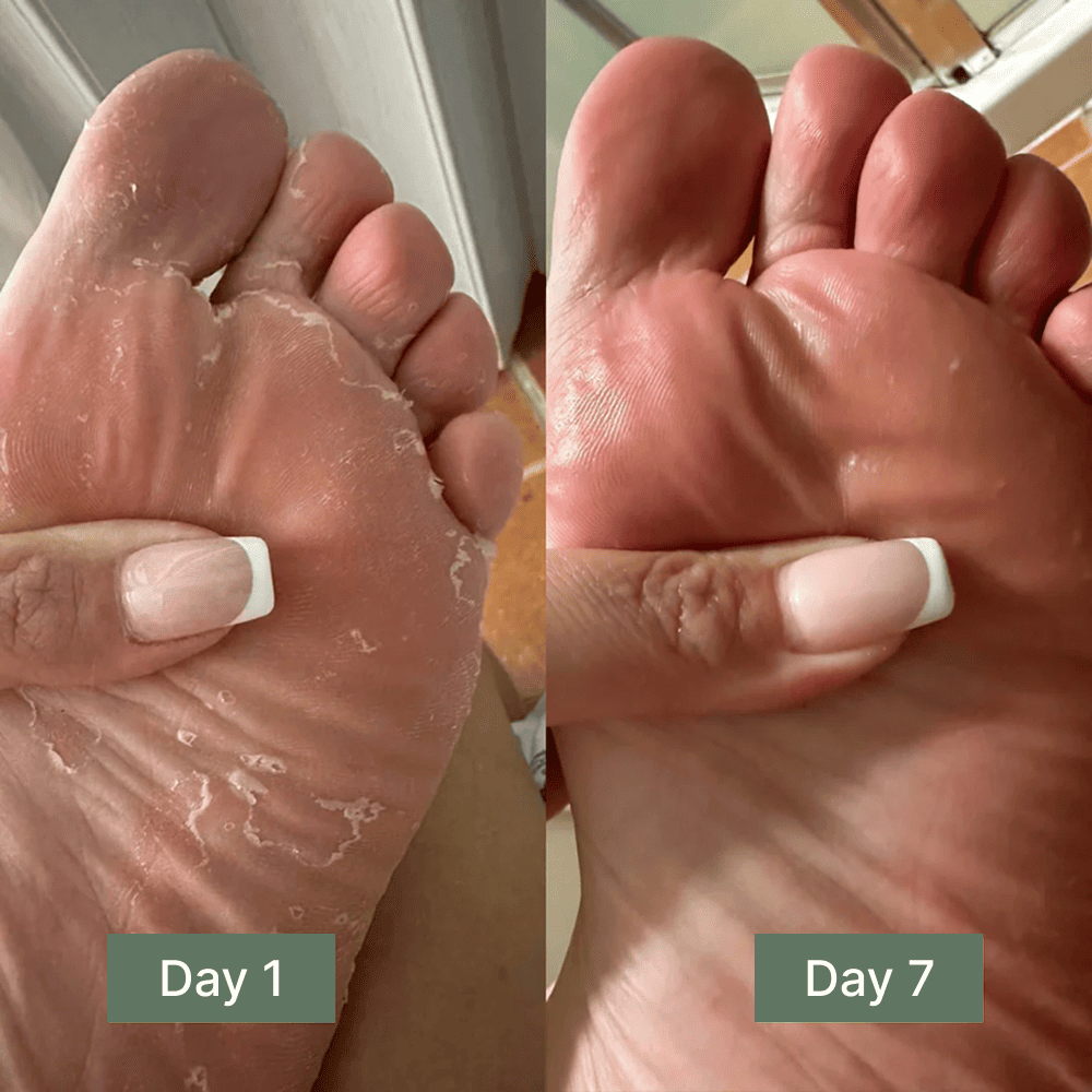 Clinical Antifungal Soap